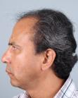 Before Hair Transplant&nbsp;Front